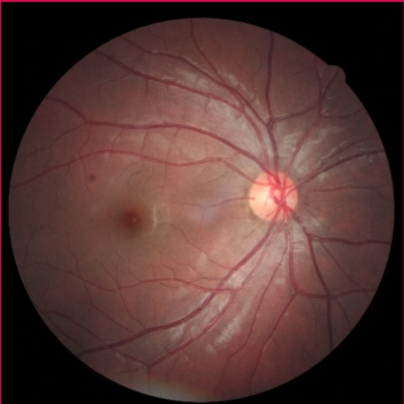 Diabetic Retinopathy